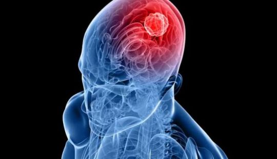 Simptomele unei tumori cerebrale