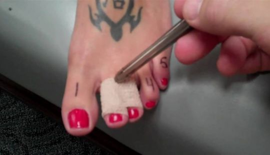 Cum se trateaza degetele luxate?