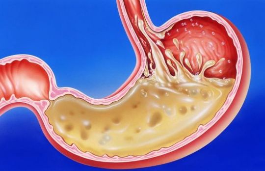 Cum afli daca ai probleme gastrice