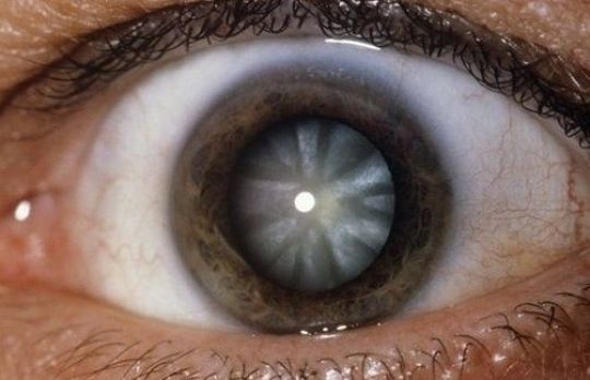 Cum sa tratezi CATARACTA. Incearca aceste remedii naturale 