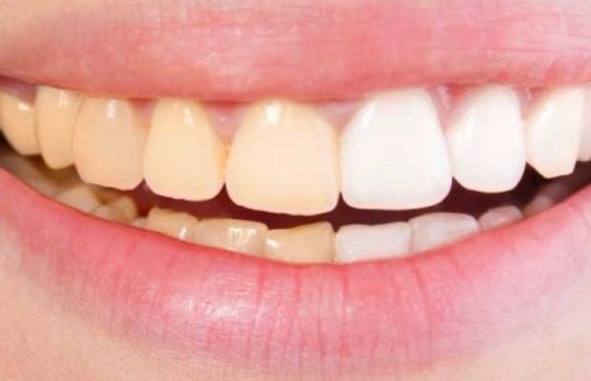 Ti s-au ingalbenit dintii? Iata cum poti rezolva aceasta problema