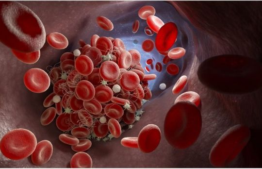 Cum sa recunosti un cheag de sange. Sunt 7 zone in care se formeaza