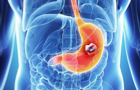 Cum sa identifici cancerul de stomac