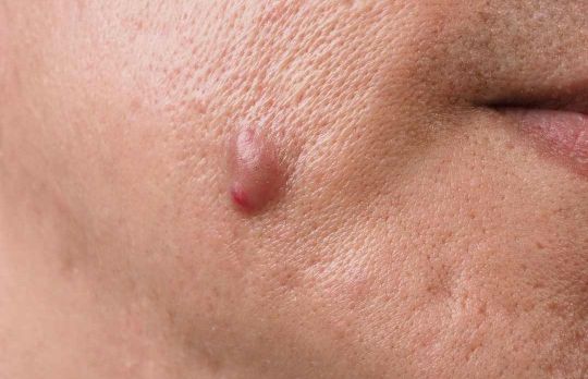 Cum sa scapi de acneea chistica