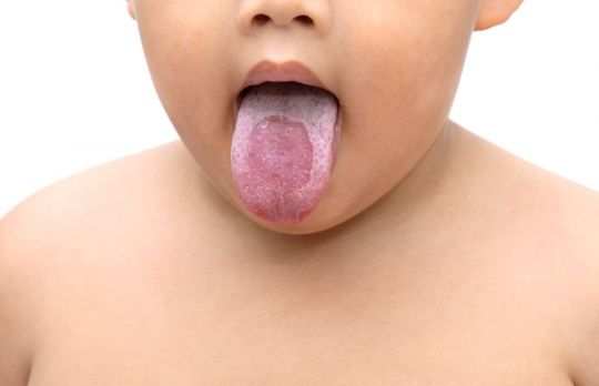Bebelusi. Cum sa tratezi candidoza bucala