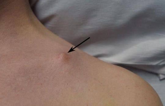 Cum sa te recuperezi dupa o ruptura de clavicula