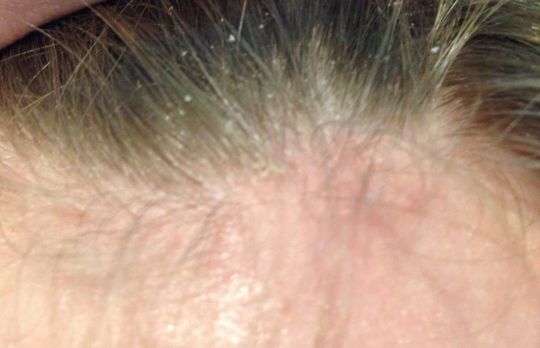 Cum sa tratezi dermatita seboreica