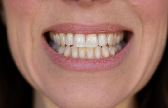 Cum sa iti mentii dintii albi si sanatosi. 6 metode naturale